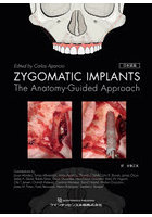 ZYGOMATIC IMPLANTS The Anatomy-Guided Approach 日本語版